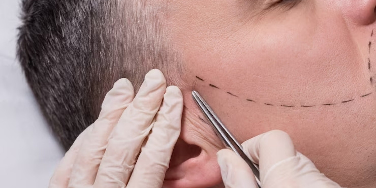 Affordable Facial Hair Transplant Costs in Palm Desert